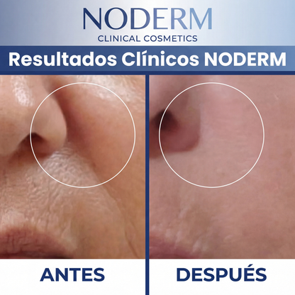Dispositivo Facial de Alta Frecuencia Noderm® NE