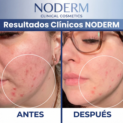 Dispositivo Facial de Alta Frecuencia Noderm® AR