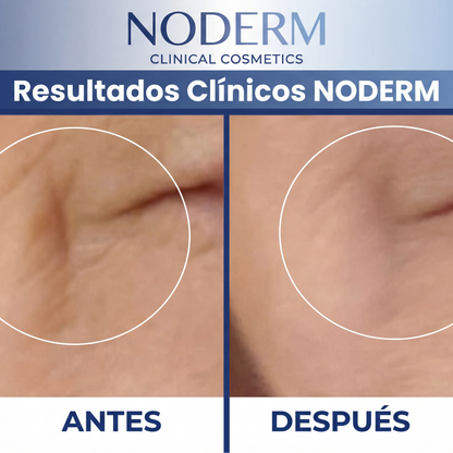Dispositivo Facial de Alta Frecuencia Noderm® NE